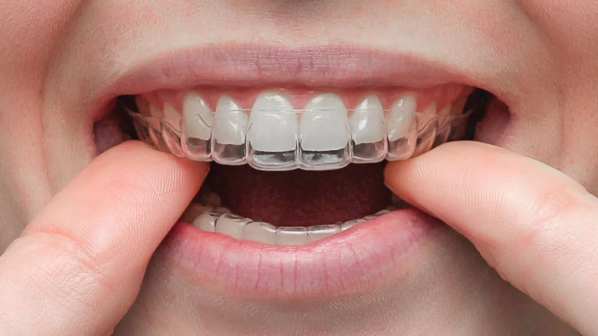 Aligners